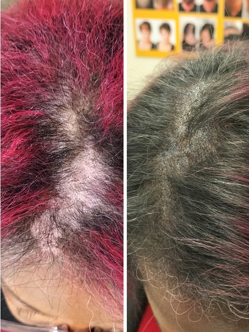 Scalp Micropigmentation Before and After