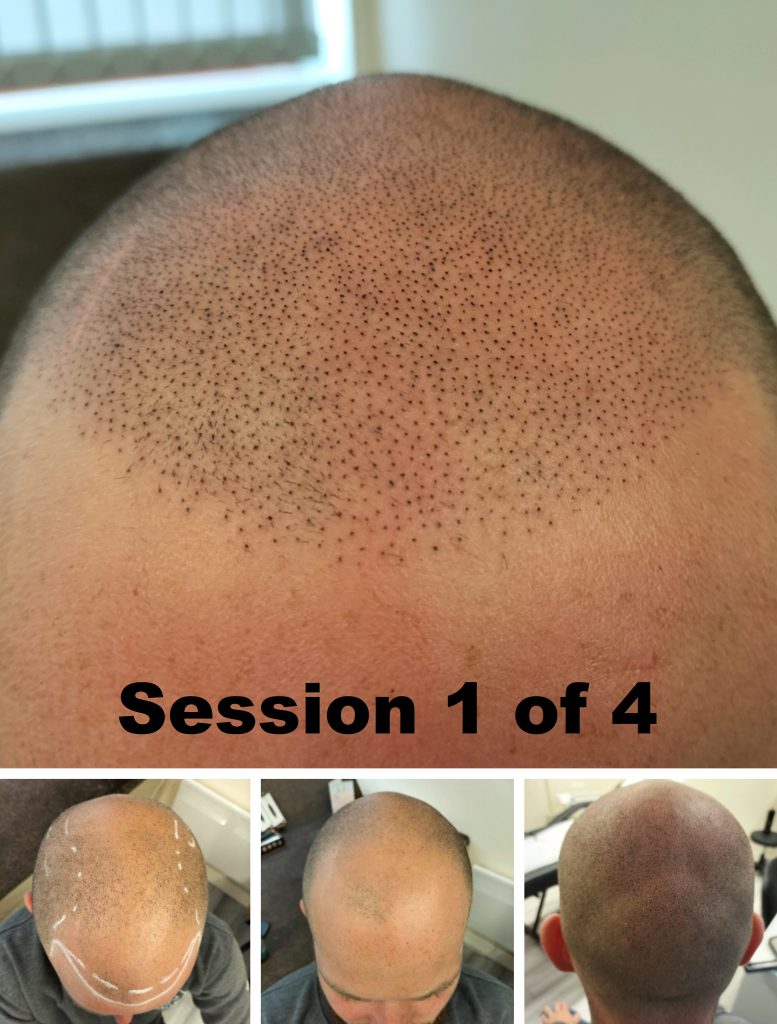 scalp micropigmentation leicester
