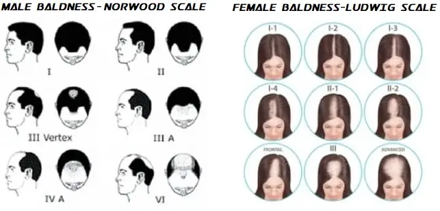 pattern baldness scale
