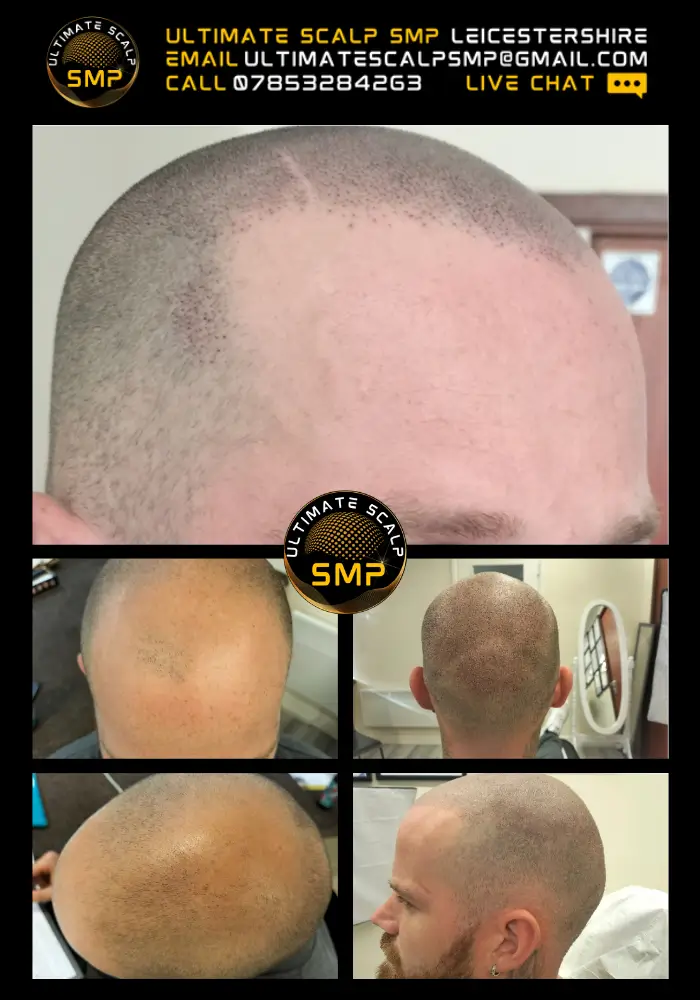 scalp micropigmentation leicester